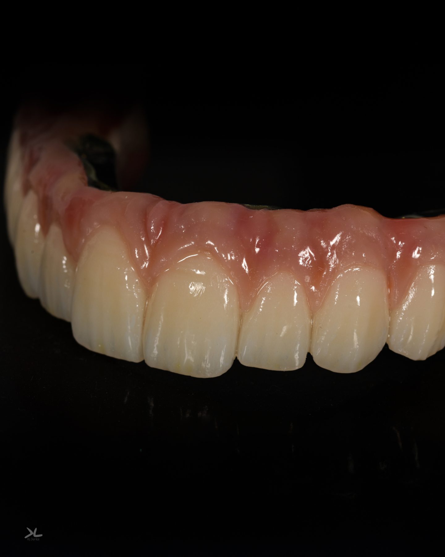 Puente completo sobre implantes con encía cerámica