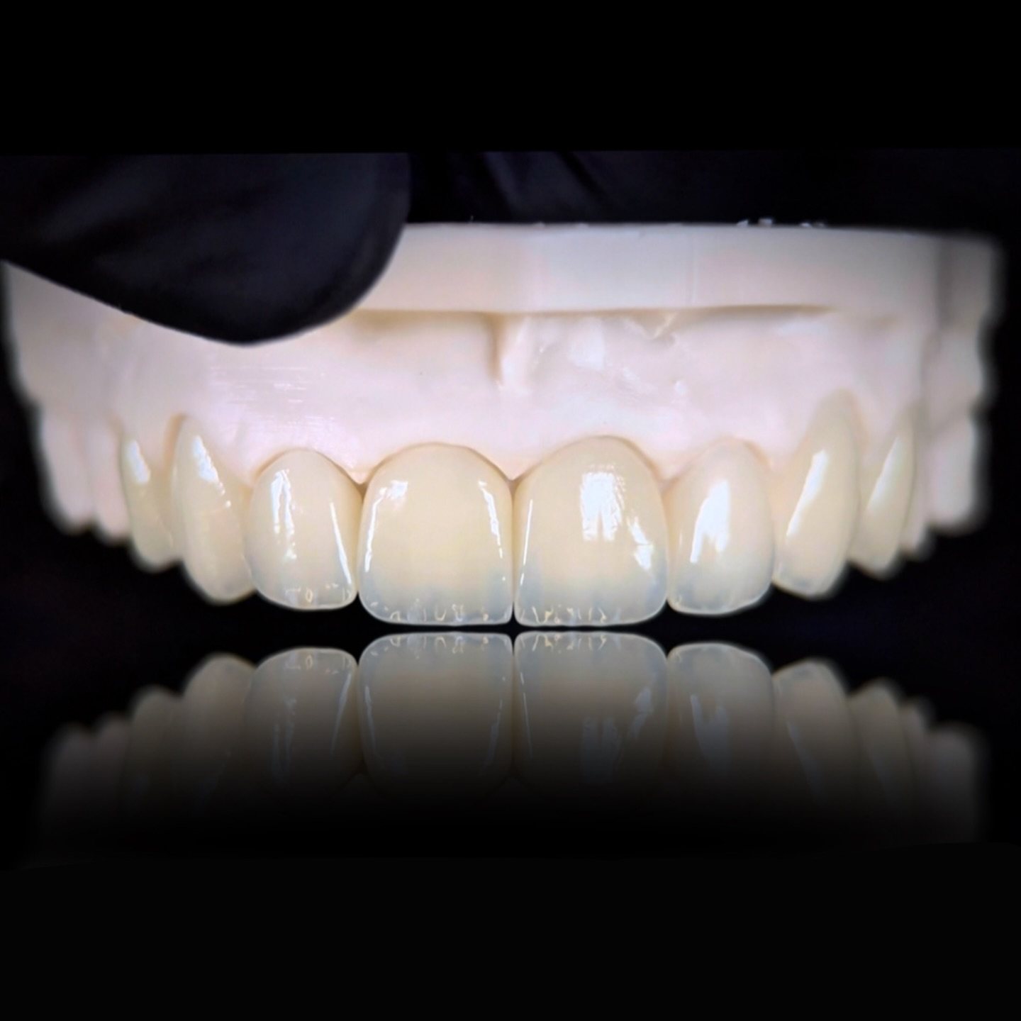 Carillas de disilicato y diseño de sonrisa fabricadas por KL Dental Lab