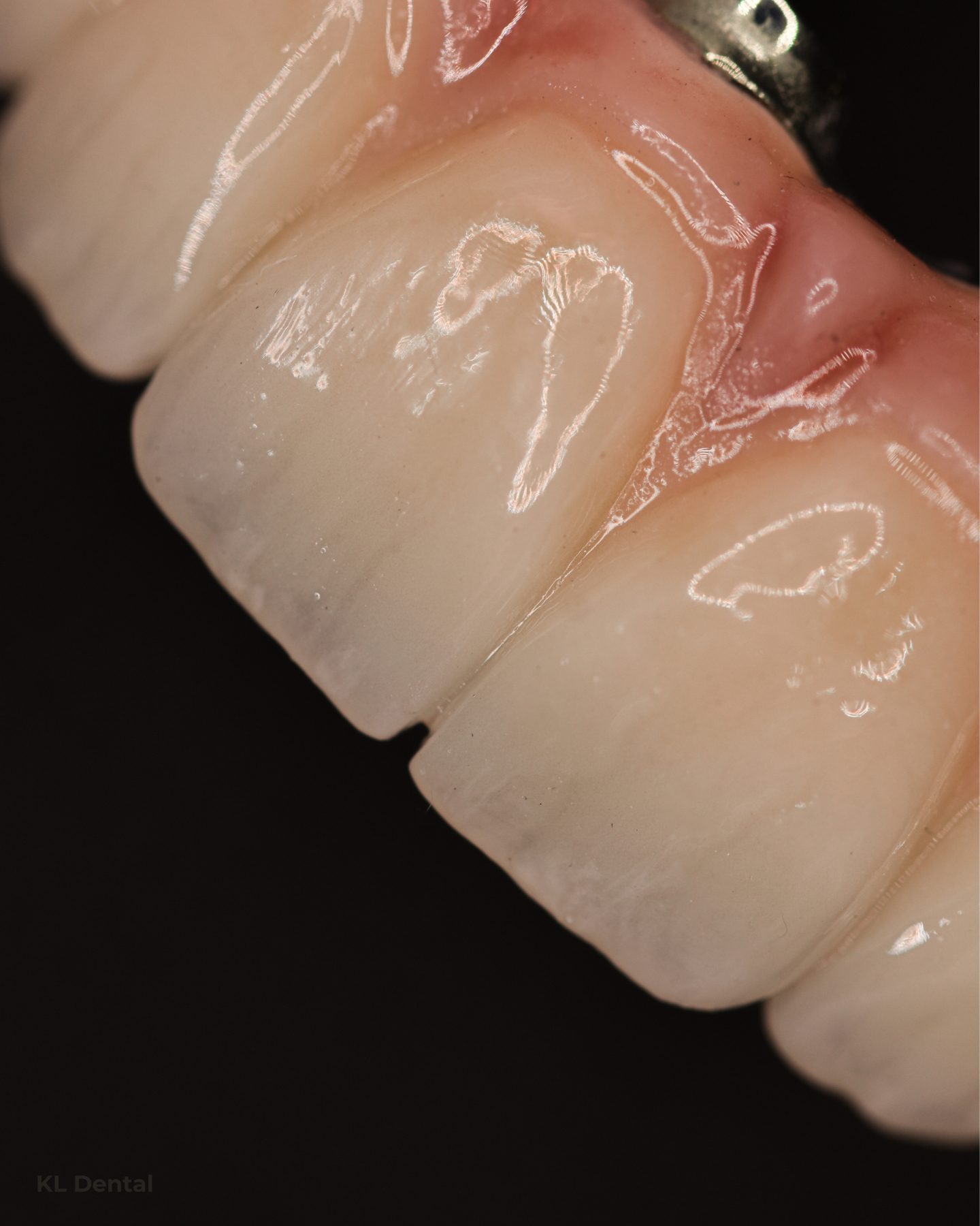 Detalle de coronas de zirconio