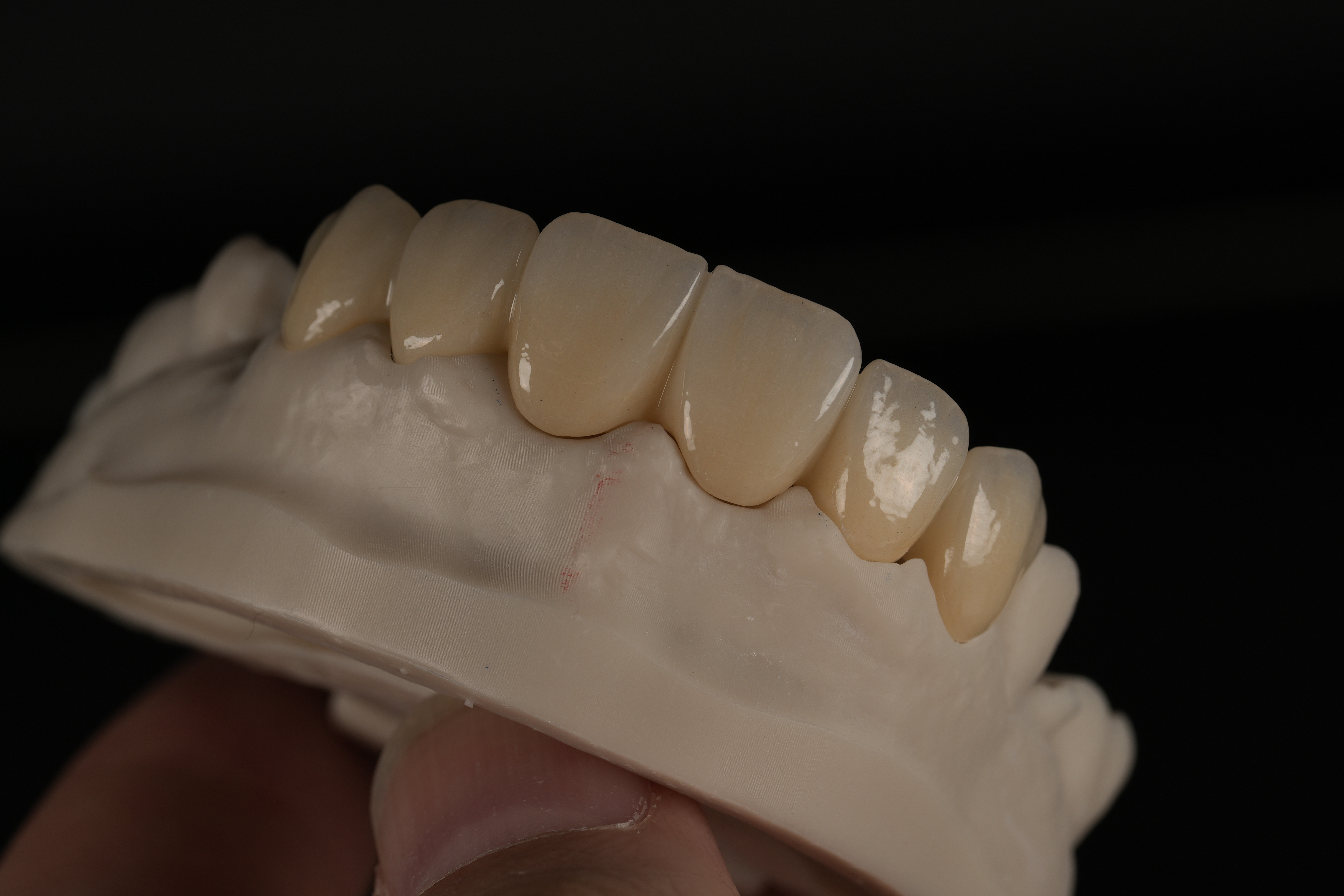 Vista oblicua de las restauraciones anteriores sobre un modelo dental