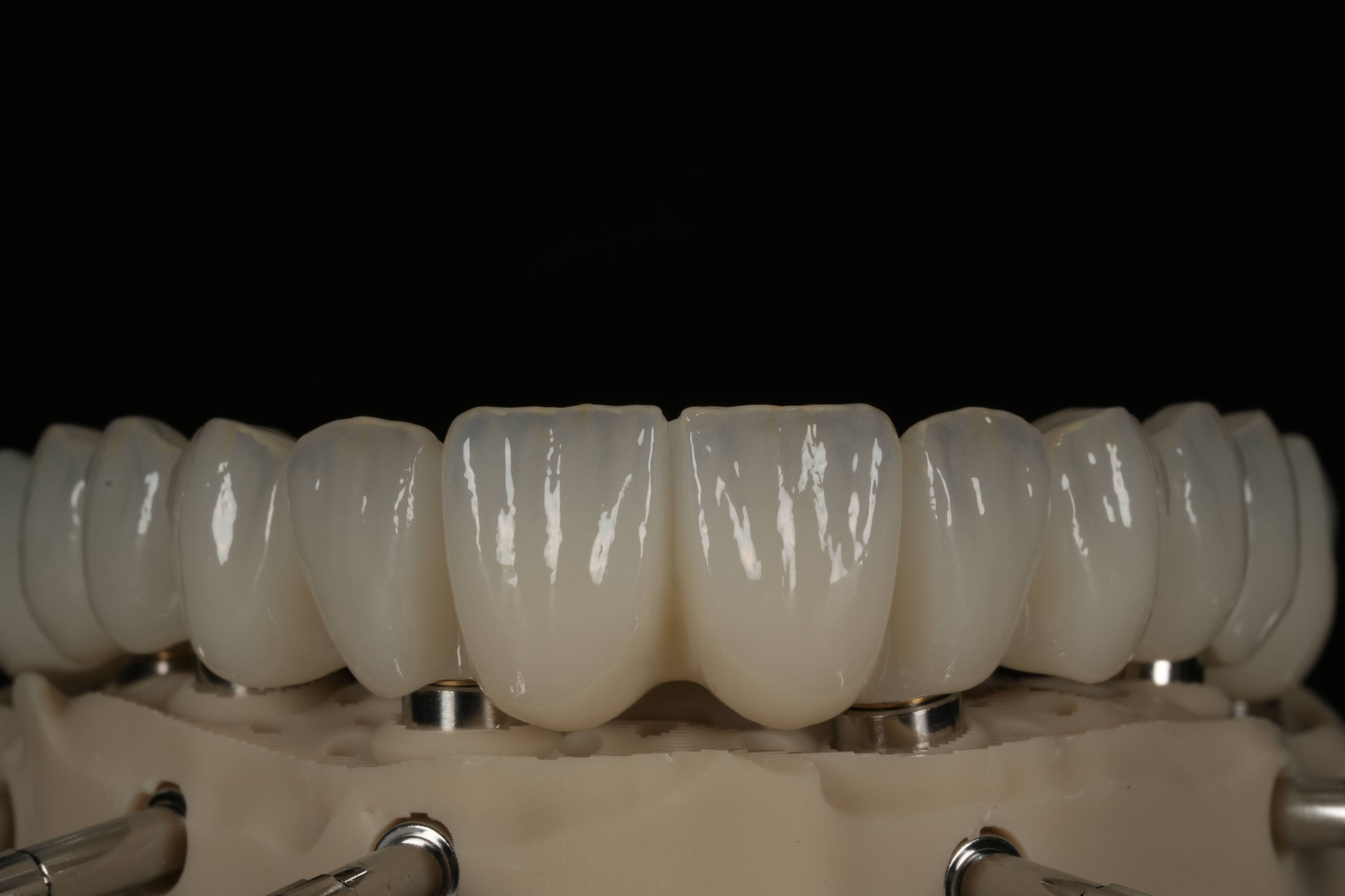 Vista frontal de una arcada sobre pilares de implantes
