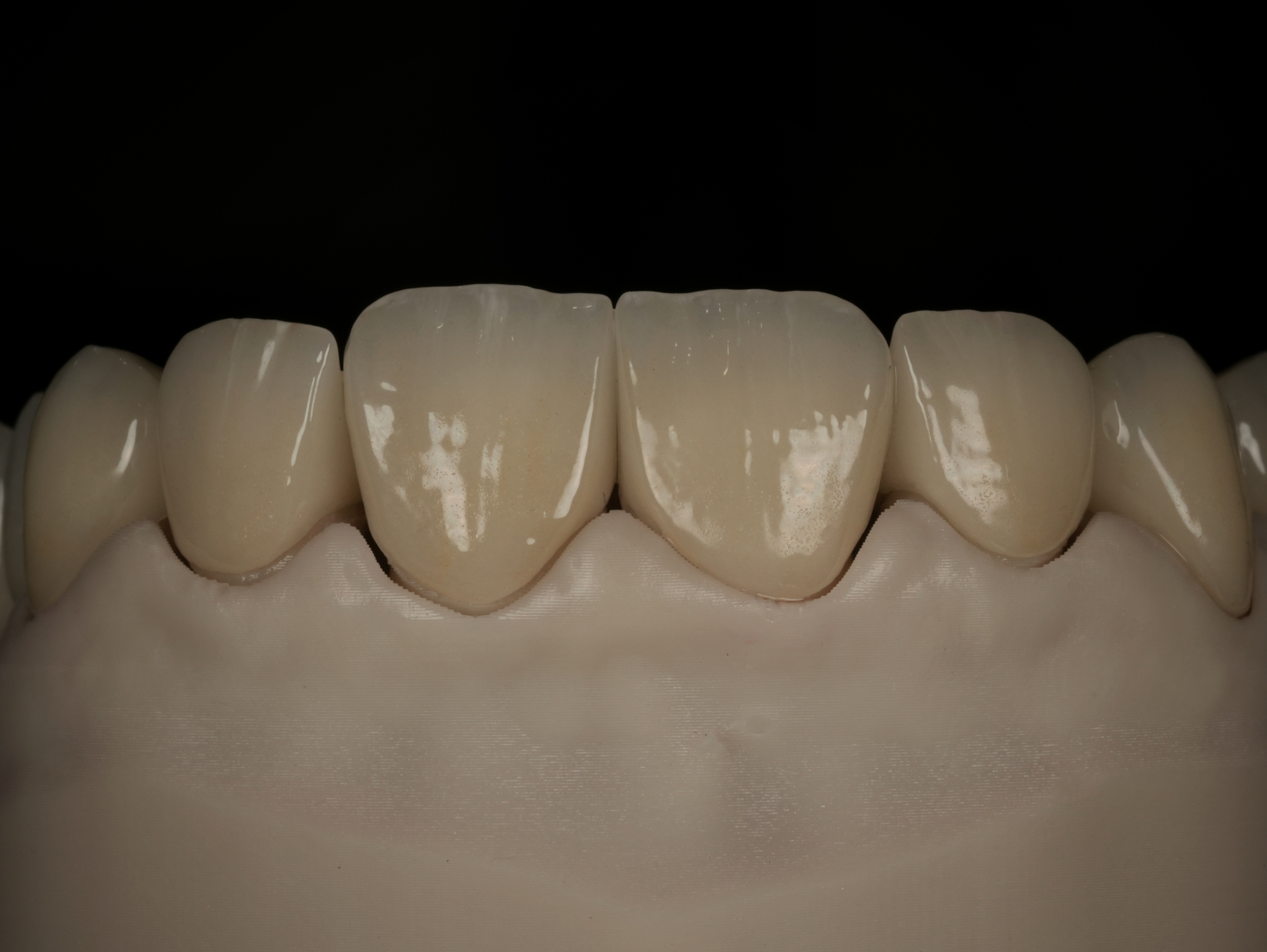 Vista frontal de las coronas sobre un modelo dental
