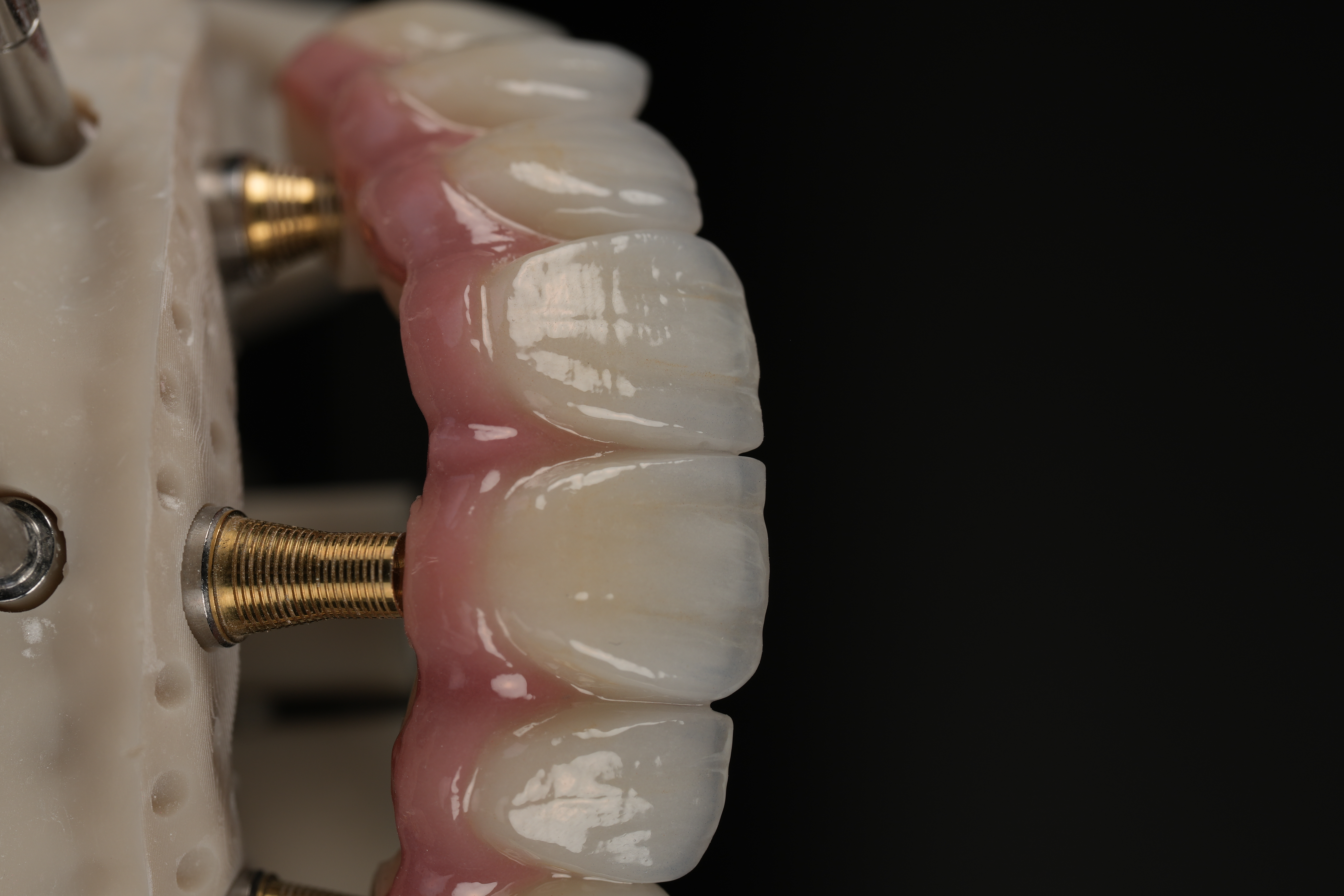 Detalle de dientes, encía protésica y pilar sobre un modelo dental