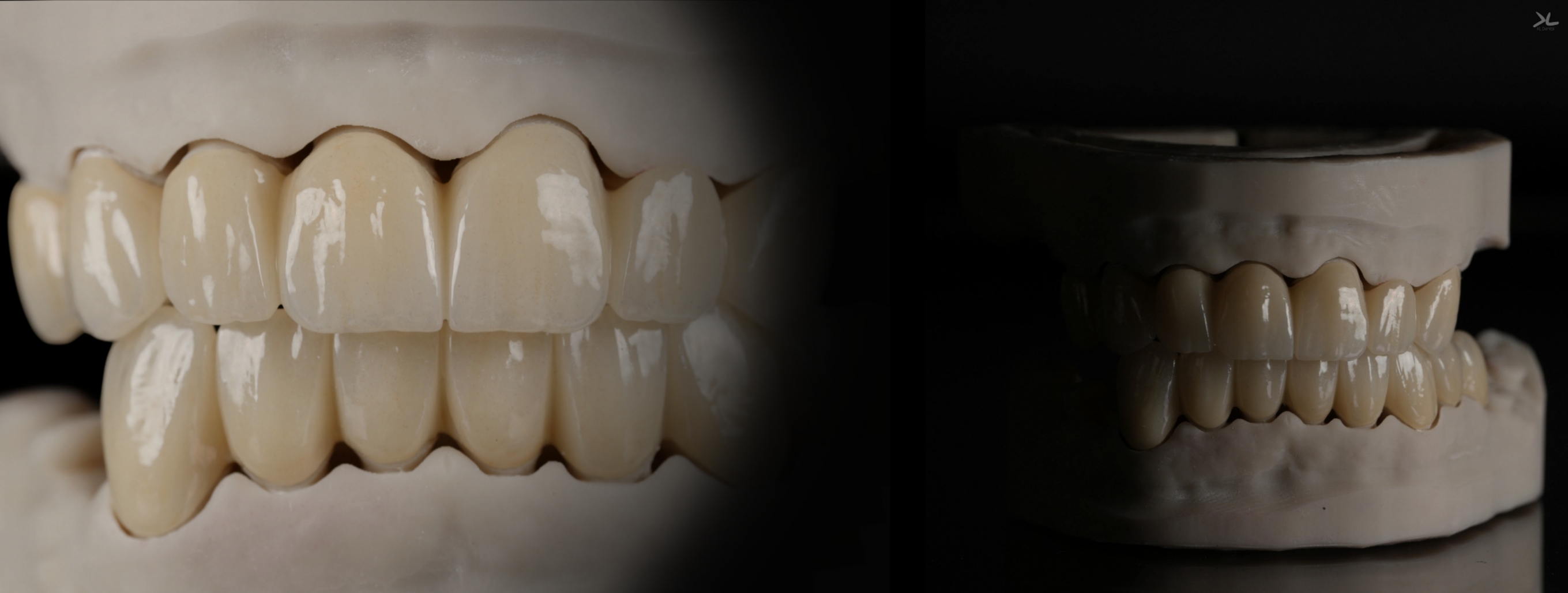 Dos vistas de las arcadas en oclusión sobre modelos dentales