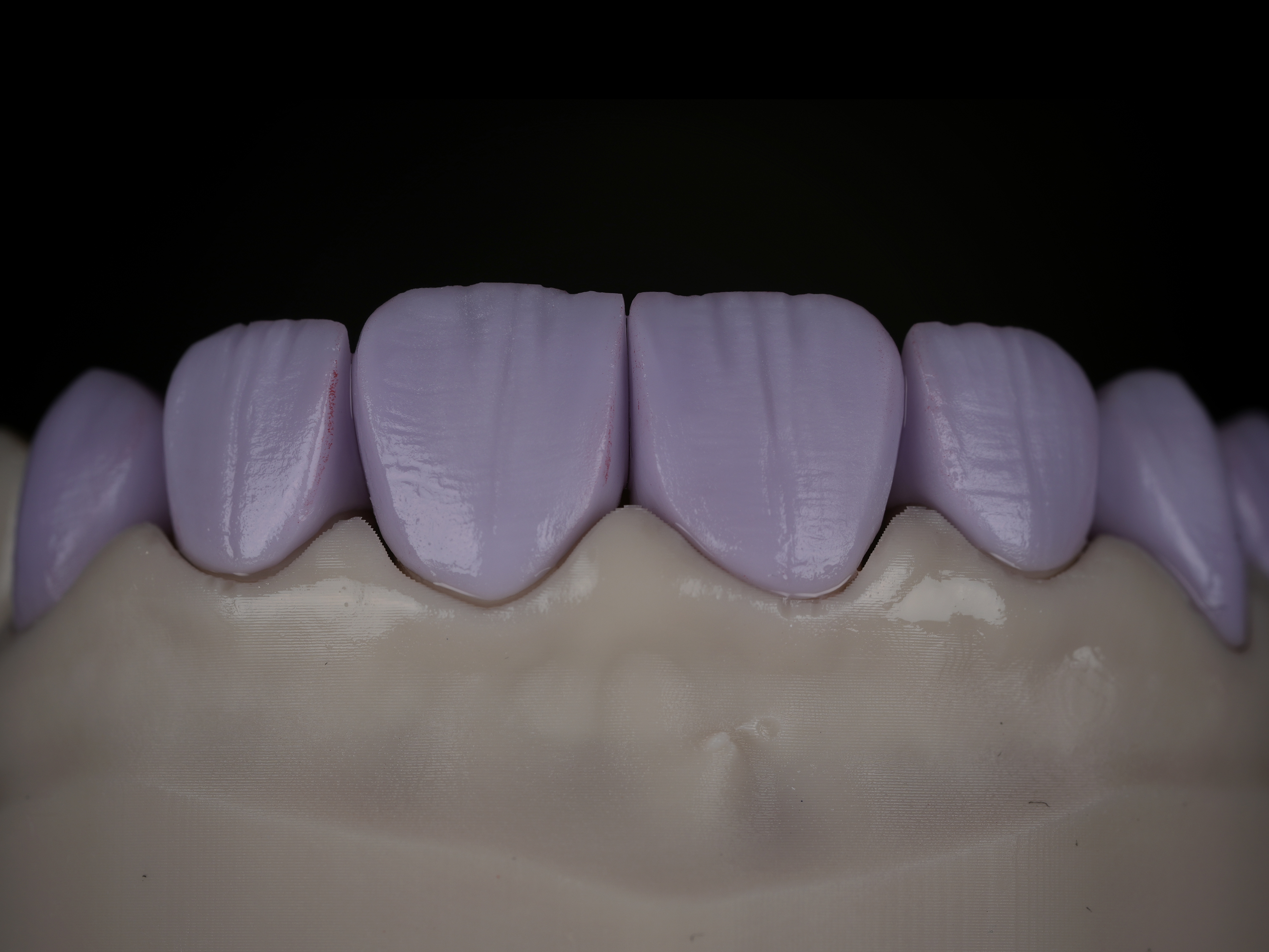 Piezas de tono violeta durante el proceso de fabricación sobre un modelo dental
